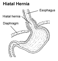 Hiatal Hernia Diagram