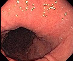 Hiatal Hernia Forward View