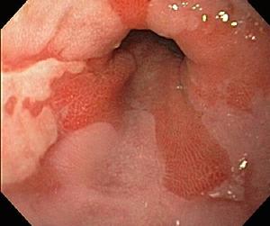 Barrett's Esophagus