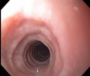 Eosinophilic Esophagitis