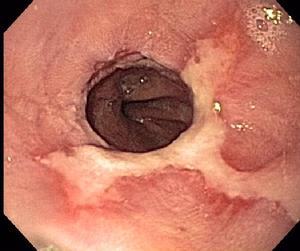 Severe Erosive Esophagitis