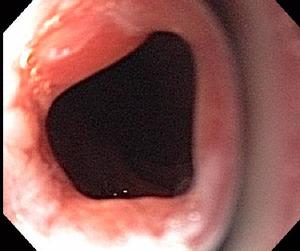 Esophageal Stricture - Obstructing