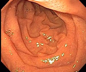 Normal Duodenum