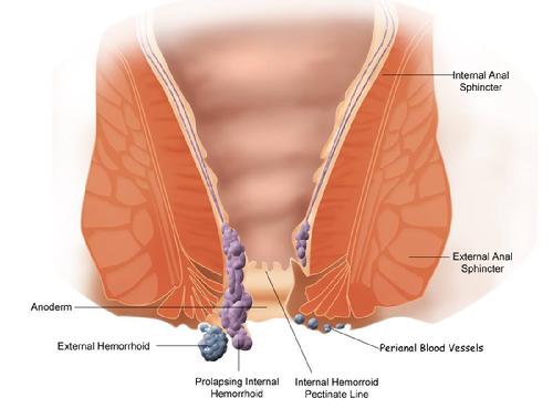 Hemorrhoid anatomy (Wikipedia)